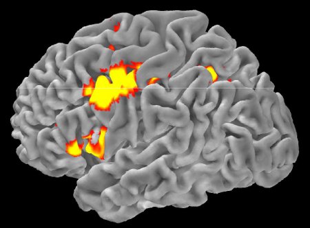Figura 2. Aree frontali e parietali attivate nell’emisfero sinistro durante un compito di Risonanza Magnetica funzionale che richiede l’elaborazione di rappresentazioni ortografiche (Miceli, dati personali). Figura 2. Aree frontali e parietali attivate nell’emisfero sinistro durante un compito di Risonanza Magnetica funzionale che richiede l’elaborazione di rappresentazioni ortografiche (Miceli, dati personali).